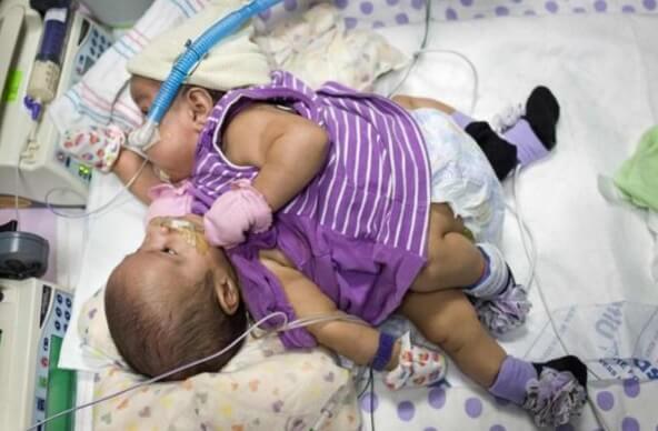 Rare Conjoined Twins Sharing All Vital Organs Except Brain Born In Mumbai