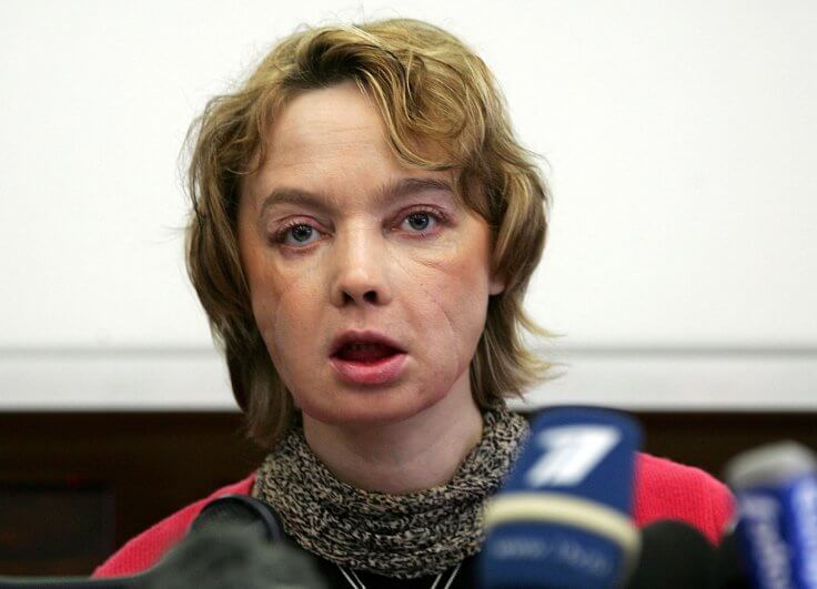 World’s First Face Transplant Recipient Dies Due To Prolonged Illness