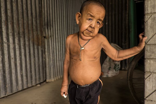 Baby With Rare Genetic Disorder Born In Bangladesh. He Will Age 8 Times Faster Than Others
