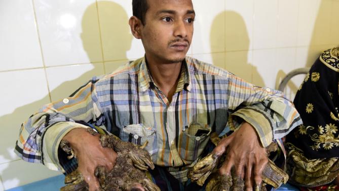 Bangladeshâ€™s â€˜Tree Manâ€™ Now Hopes To Lead Normal Life After Successful Surgery