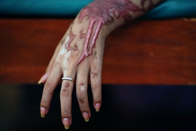 â€™Jiltedâ€™ 19-Year-Old Boy Throws Acid On Schoolgirl In Punjab, But Burns 5 Of Her Friends Too