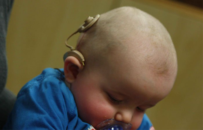 Cochlear Implants For Hearing-Impaired Children May Cost Just Rs 1 Lakh