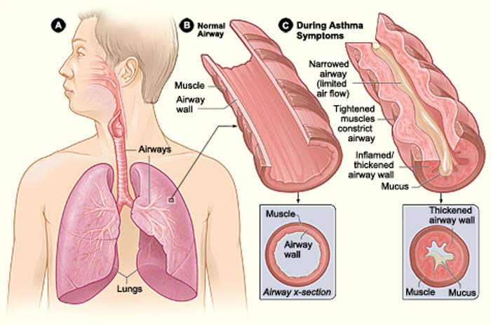 50% Of Asthmatics Do not Really Have The Disease Often Misdiagnosed Say Experts