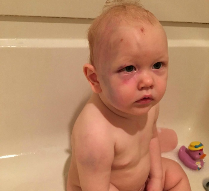 One-Year-Old Boy Gets Beaten Up By Babysitter Parents Recieve No Support From The Law